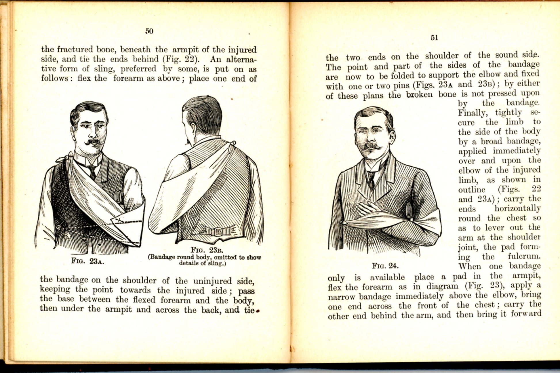 FIRST AID TO THE INJURED St. John's Association ©1901 Bone injuries